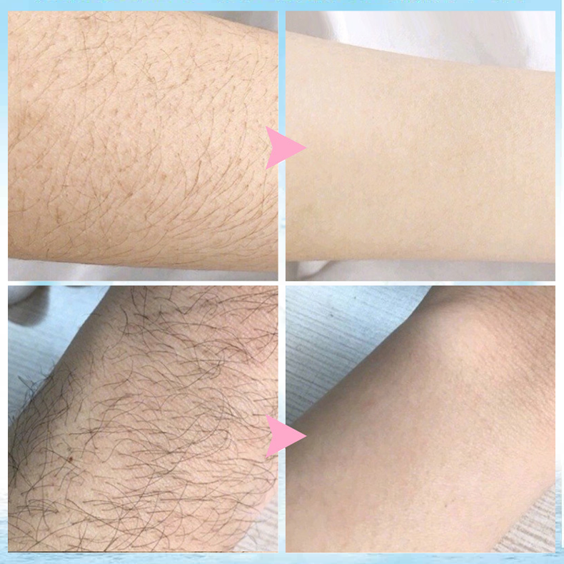 đ„ Magic Hair Removal & Hair InhibitorăBuy 5+ Get Extra 25% OFFă